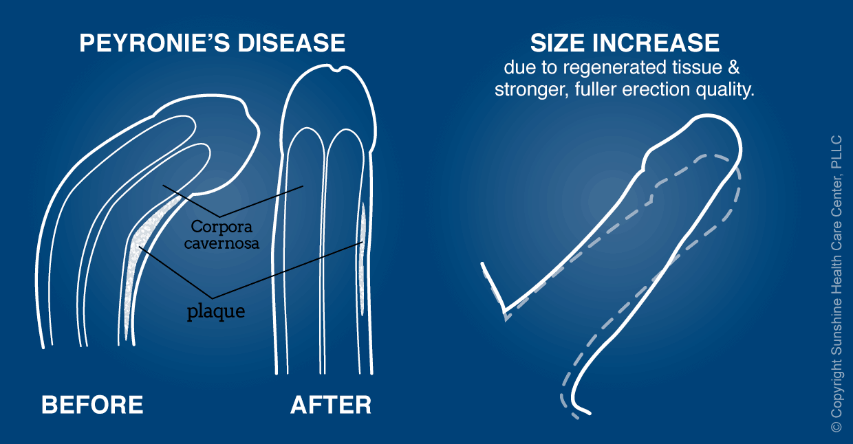 Apollo Shot<sup>©</sup> Before and After treating Peyronie’s Disease artist rendition