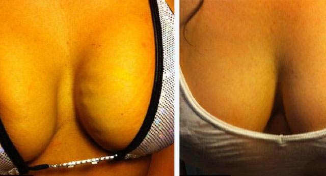 PRP Breastlift before and after on breast implants