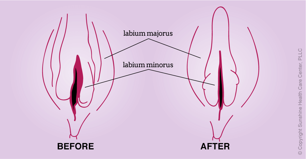 Vaginal Winglift Before and After artist rendition