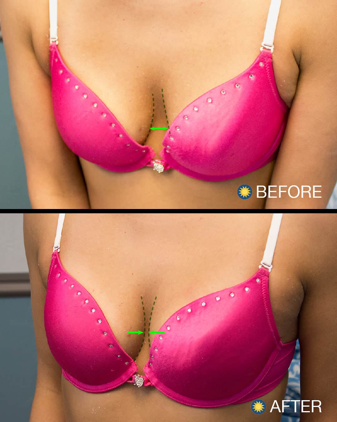 Breastlift patient of Sunshine Health Care Center, Before and After picture 
