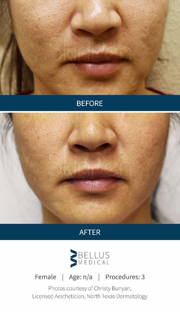 SkinPen® before and after 7