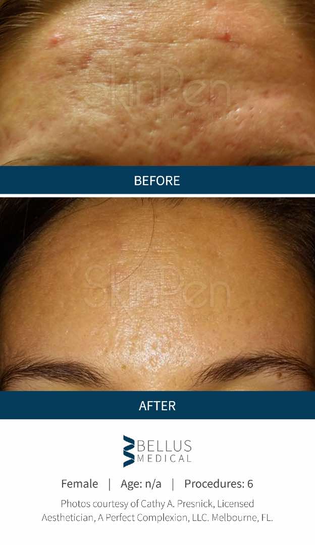 SkinPen® before and after 6