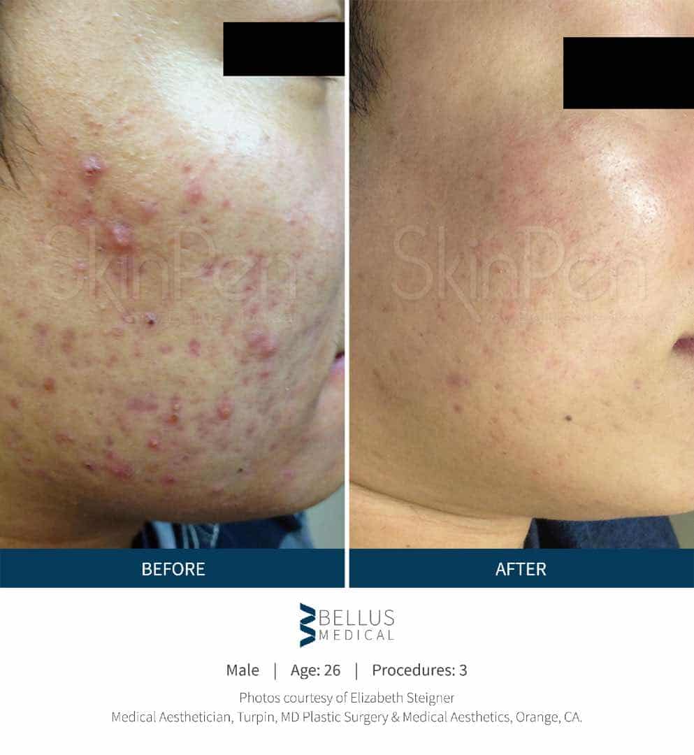 SkinPen® before and after 2