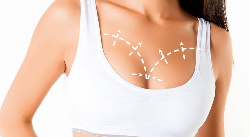 PRP Breastlift injections